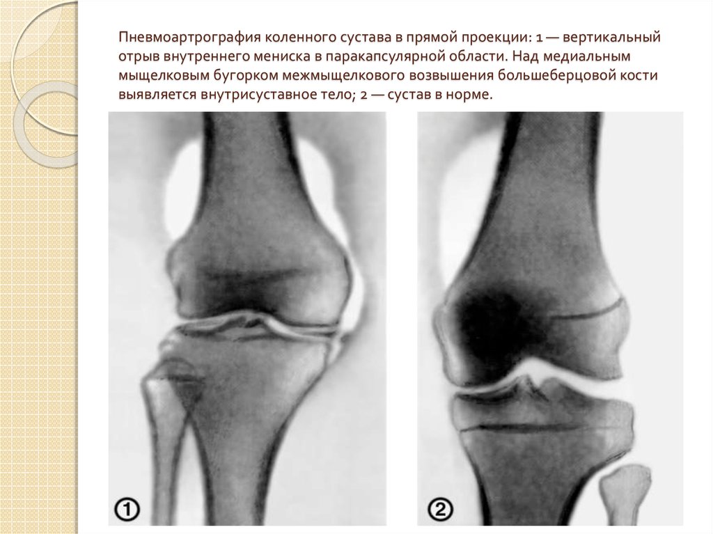 Мениск коленного сустава картинки