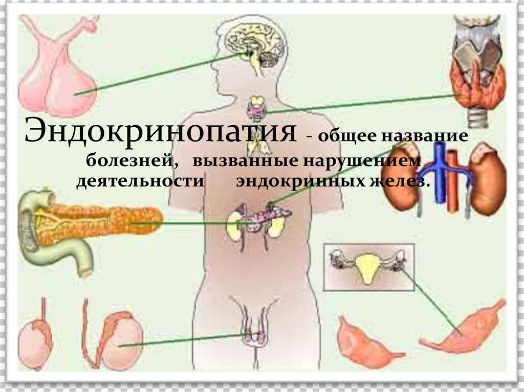 Эндокринопатия что это такое простыми словами