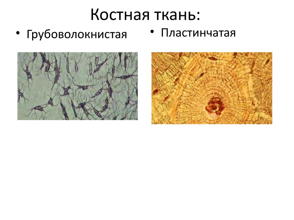 Виды костной. Грубоволокнистая костная ткань препарат. Ретикулофиброзная костная ткань. Ретикулофиброзная (грубоволокнистая) костная ткань. Тонковолокнистая пластинчатая костная ткань.