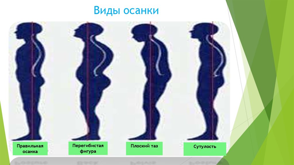 Осанка фигуры. Перегибистая осанка. Типы осанки фигуры. Типы осанки перегибестая. Осанки сутулая перегибистая.