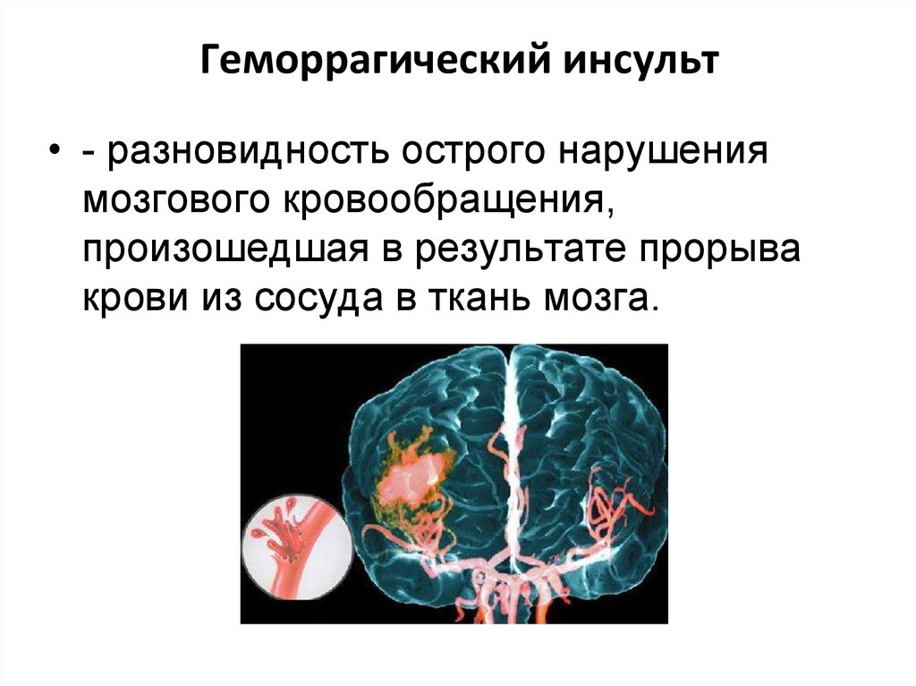 Геморрагический инсульт презентация