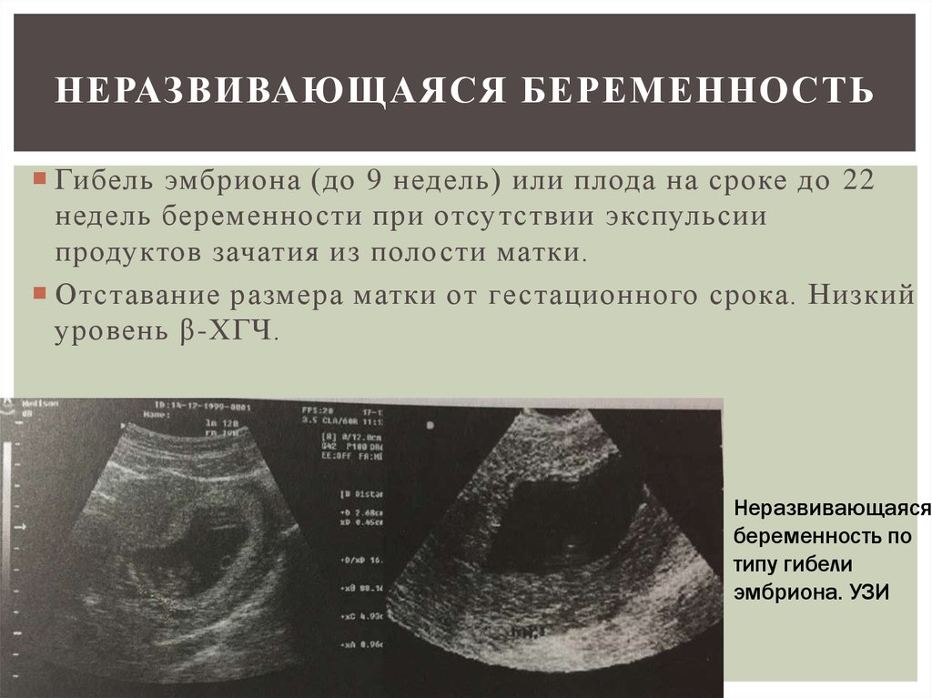 Беременность умрем. УЗИ признаки неразвивающейся беременности. Неразвивающаяся беременность на ранних сроках УЗИ. УЗИ неразвивающейся беременности 6 недель. Неразвивающиес беременность это.