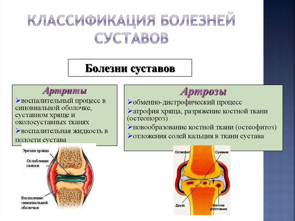 Воспаление суставов болезнь. Ревматоидный артрит классификация коленный сустав. Схема развития деформирующего остеоартроза. Болезни соединительной ткани ревматоидный артрит. Суставные поражения при ревматоидном артрите.