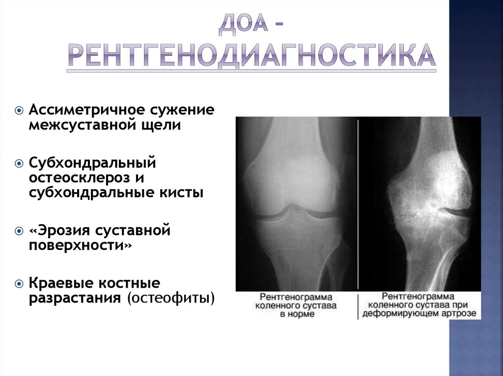 Диагноз доа суставов. Остеоартроз коленного сустава степени рентген. Деформирующий остеоартроз остеофиты. Деформирующий остеоартроз костные разрастания. Деформирующий остеоартроз симметричность.