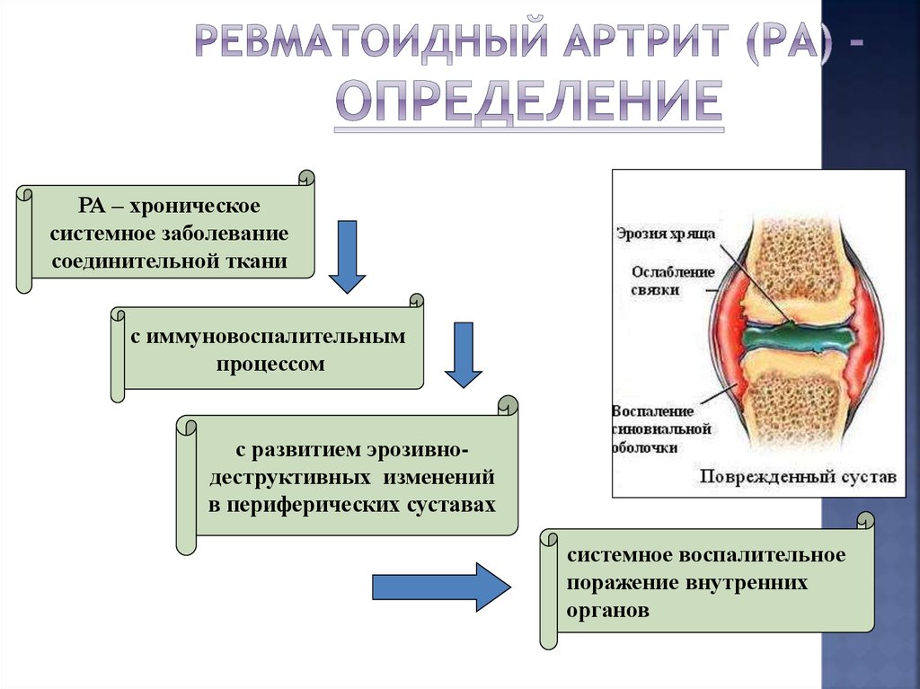 Хронические системные заболевания. Ревматоидный артрит суставов патогенез. Симптомы поражения суставов ревматоидного артрита. Основные клинические проявления ревматоидного артрита. Системные заболевания соединительной ткани.