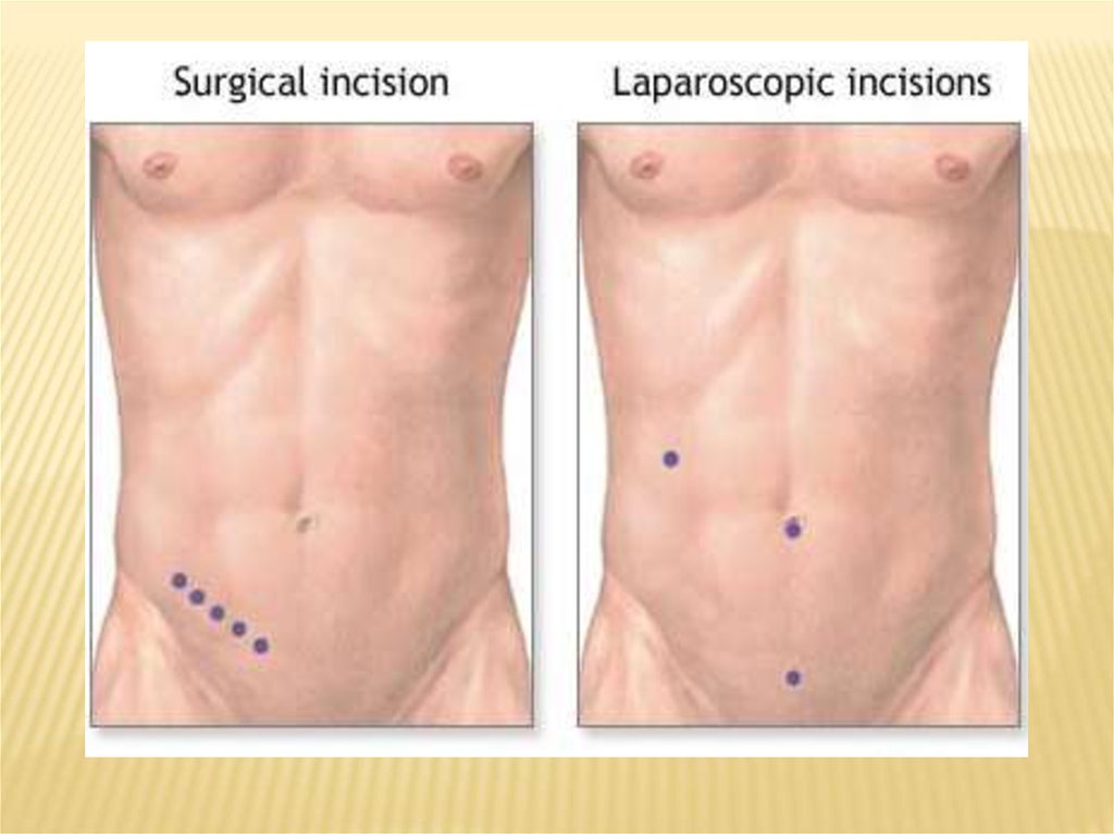 Низ живота у мужчин. Расположение аппендицита у мужчин. Лапароскопическая холецистэктомия шрамы. Лапароскопия и лапаротомия.