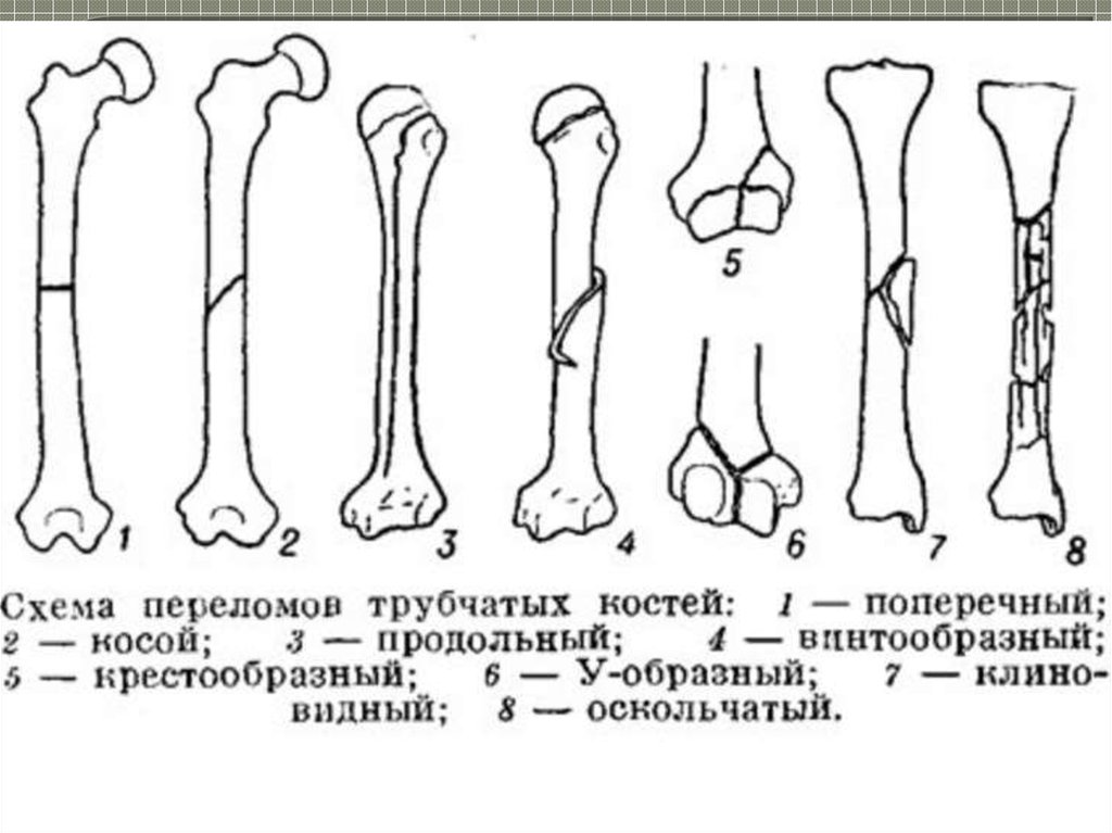 Типы закрытых переломов. Типы переломов по линии излома. Виды переломов трубчатых костей. Схема переломов трубчатых костей. Классификация перелома тручатых костей.