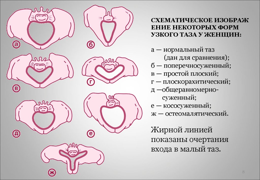 Узко понимаемый. Анатомически узкий таз формы. Формы сужения таза. Формы узкого таза в акушерстве.