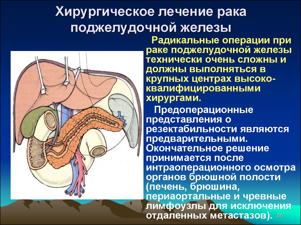 Операция головки поджелудочной железы. Операция Рамс поджелудочная железа. Операция на желудок и поджелудочную железу. Онкология поджелудочной железы. Поджелудочной железы (опухоли и панкреатит);.