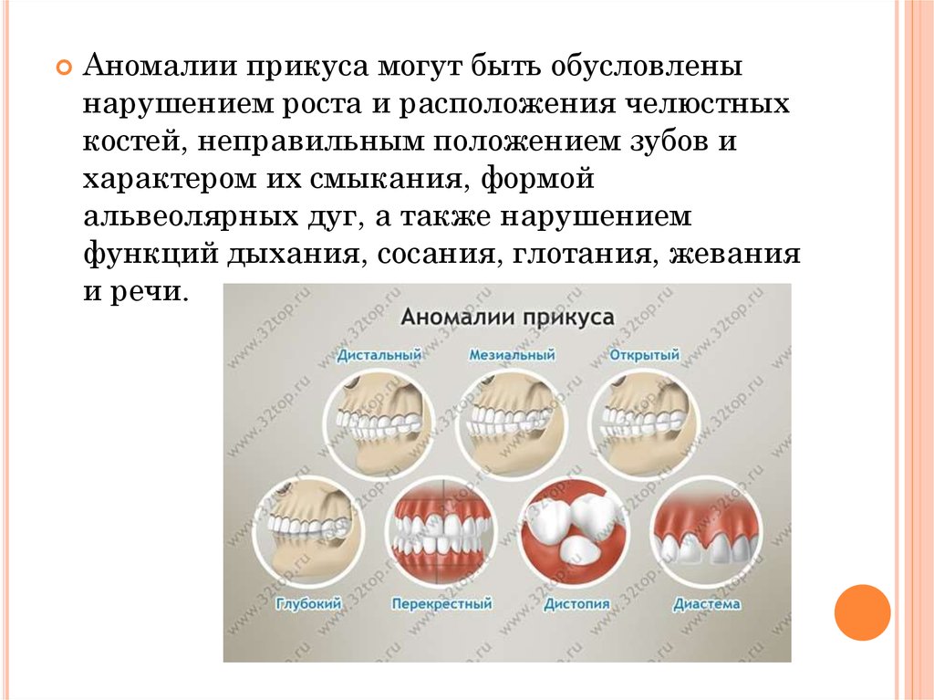 Нарушение окклюзии. Зубочелюстных аномалий прикусы. Профилактика аномалий прикуса. Профилактика формирования аномалий прикуса.