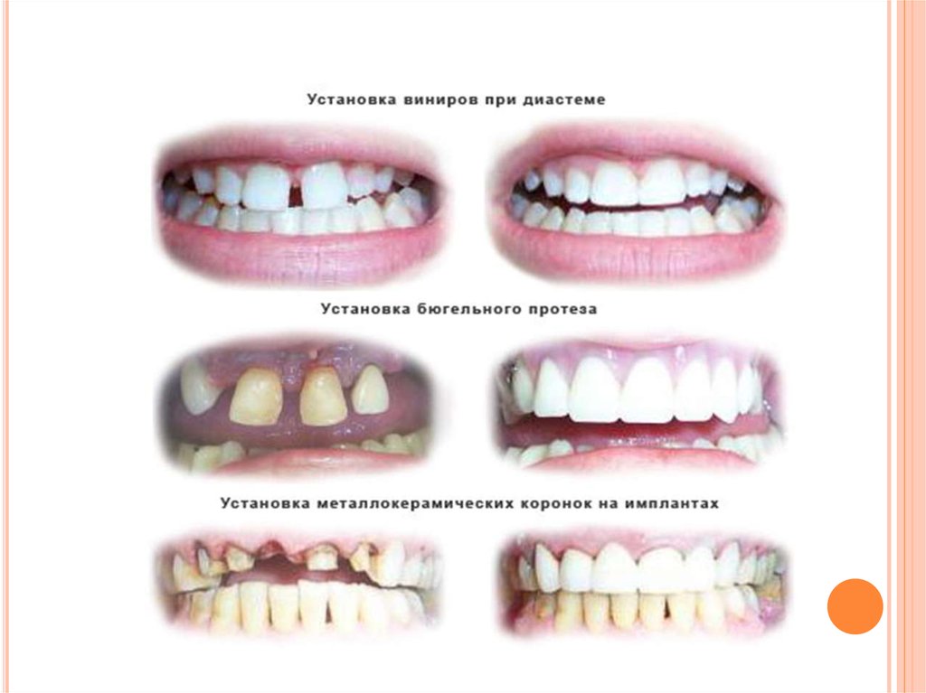 Зубное протезирование в детском возрасте презентация