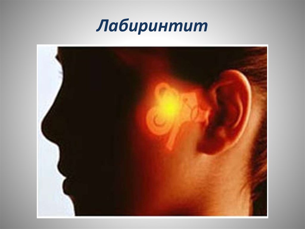 Нарушение внутреннего уха. Диффузный Гнойный лабиринтит. Гнойный лабиринтит клинические симптомы. Воспаление среднего уха (лабиринтит);. Внутренний отит (лабиринтит).