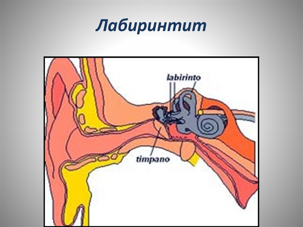 Лабиринтит это