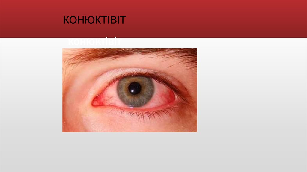конюктівіт
