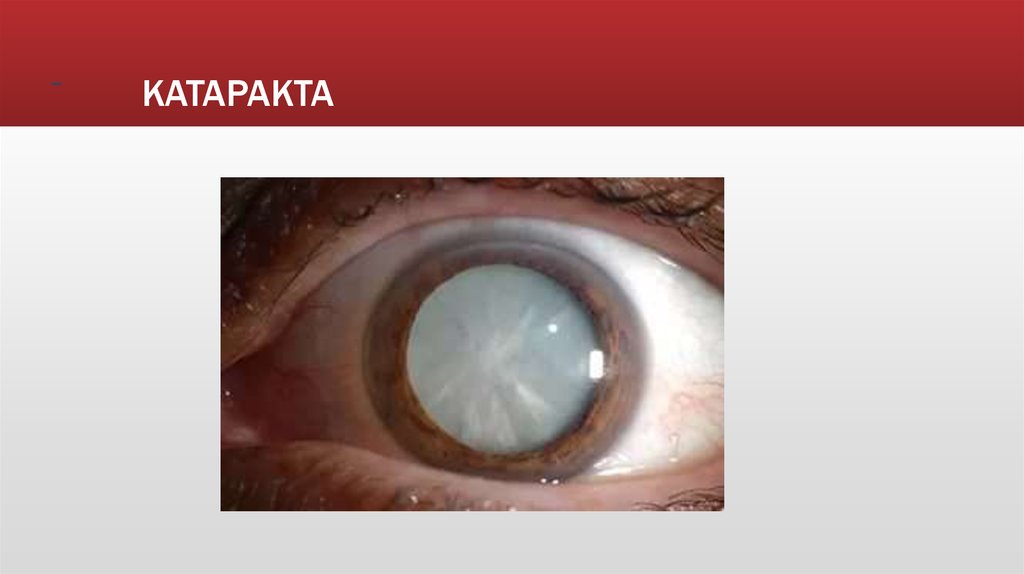 КАТАРАКТА