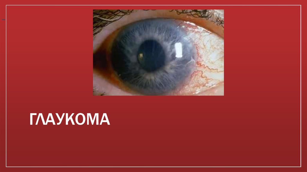 ГЛАУКОМА