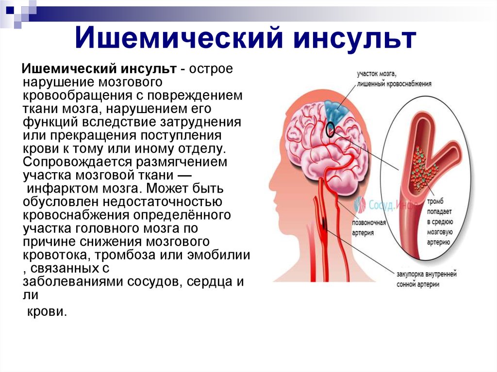 Ишемия мозга сколько живут. Ишемический инсульт головного мозга последствия. Синдромы ОНМК ишемический инсульт. Ишемический инсульт симптомы поражения. Осложнения ОНМК ишемический инсульт.