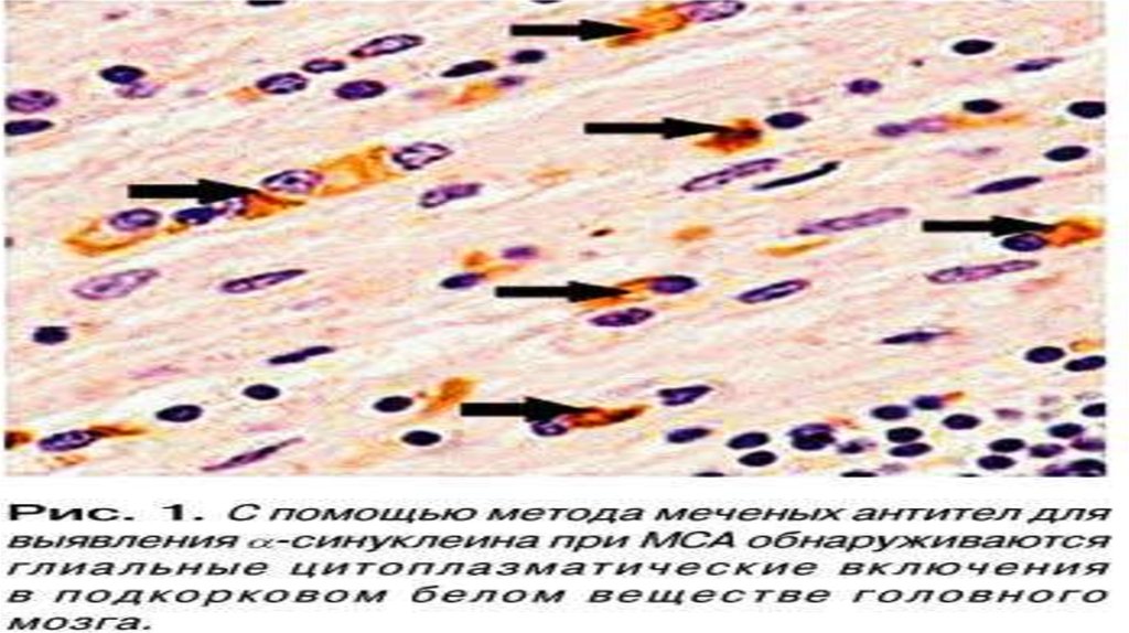 Мультисистемная атрофия головного мозга. Множественная системная атрофия. Мультисистемная атрофия мрт. Мультисистемная атрофия клинические рекомендации.