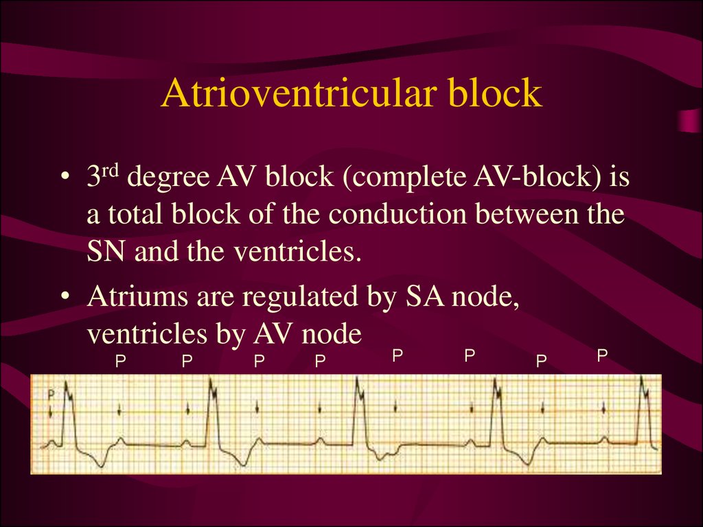 Av блок. 3rd degree av Block ECG. Av Block 3rd degree. ECG av Block 3. Atrioventricular Block.