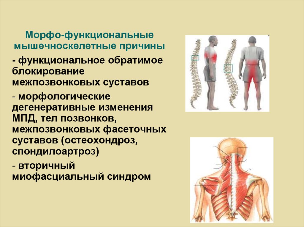 Вертеброгенная люмбалгия что это такое