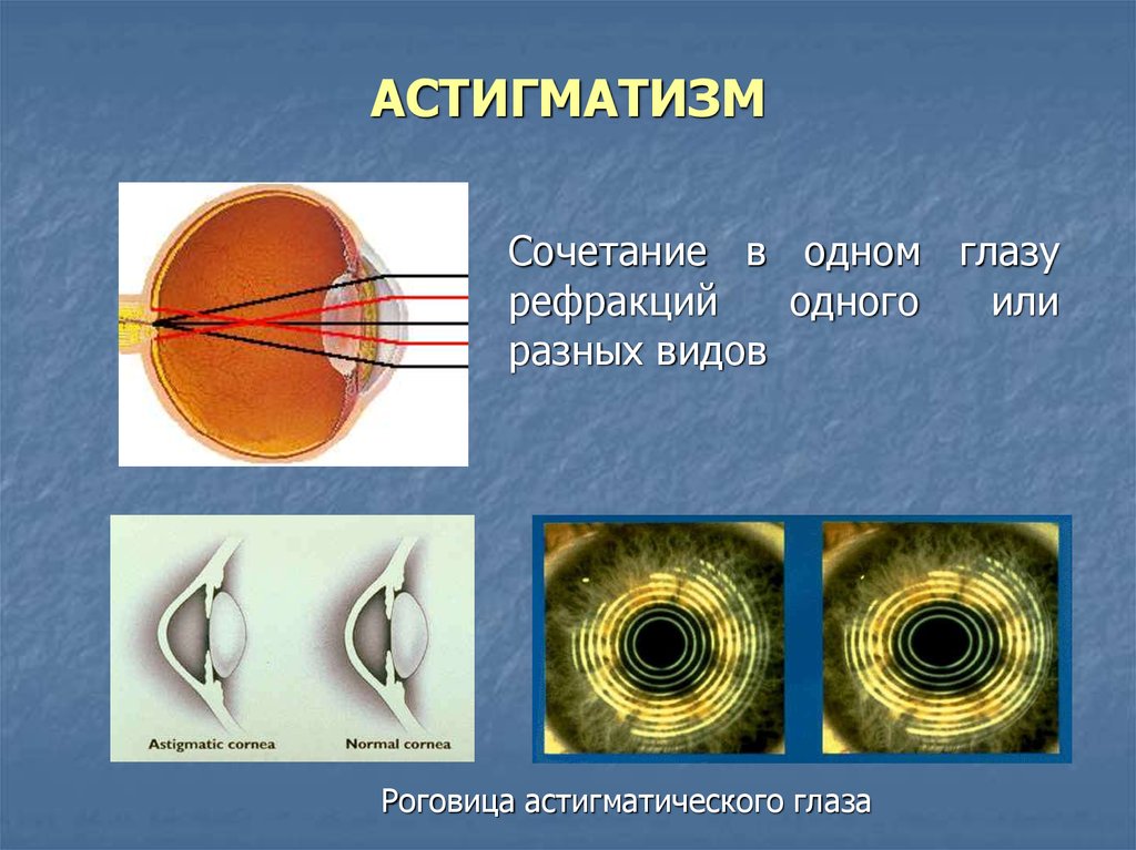 Как выглядит астигматизм фото