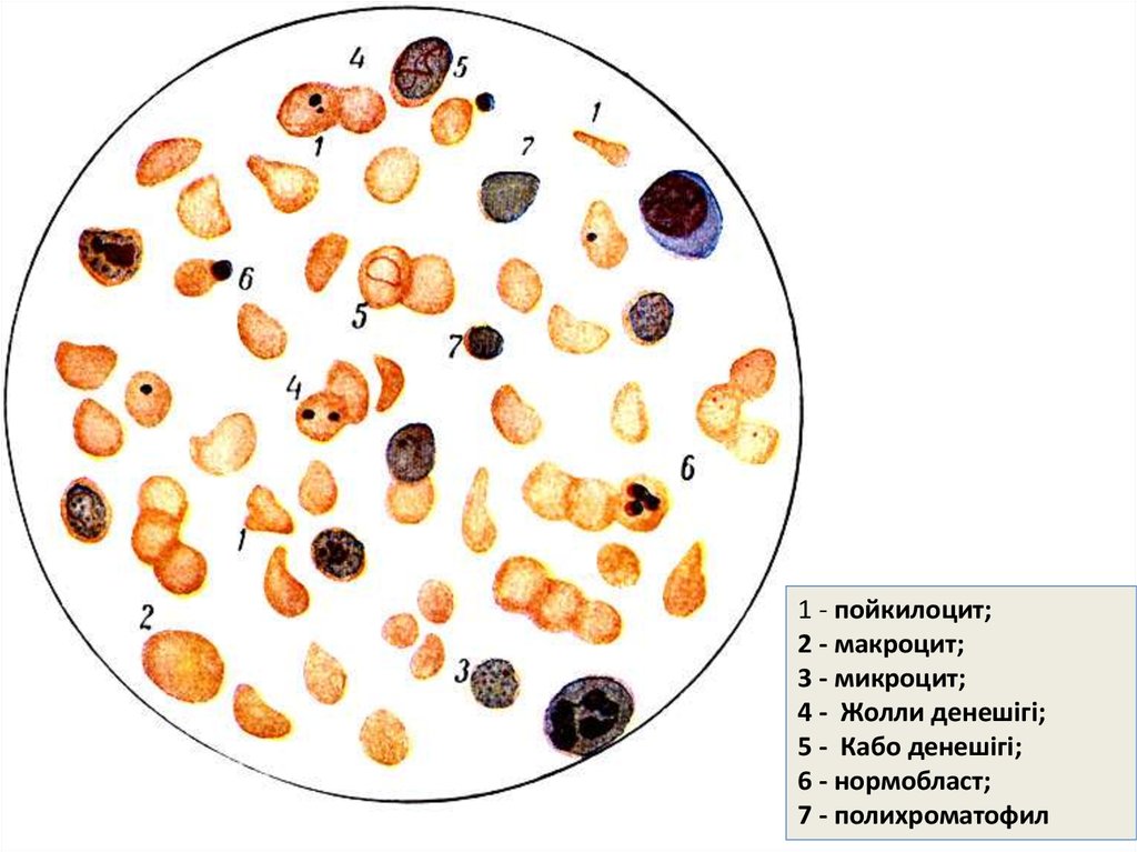 Макроциты. Тельца Жолли и кольца Кабо. Макроциты и микроциты. Полихроматофильных макроцитов.