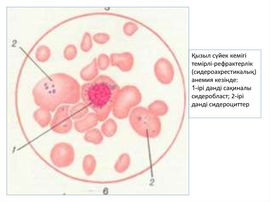 Сидеробластная анемия картина крови