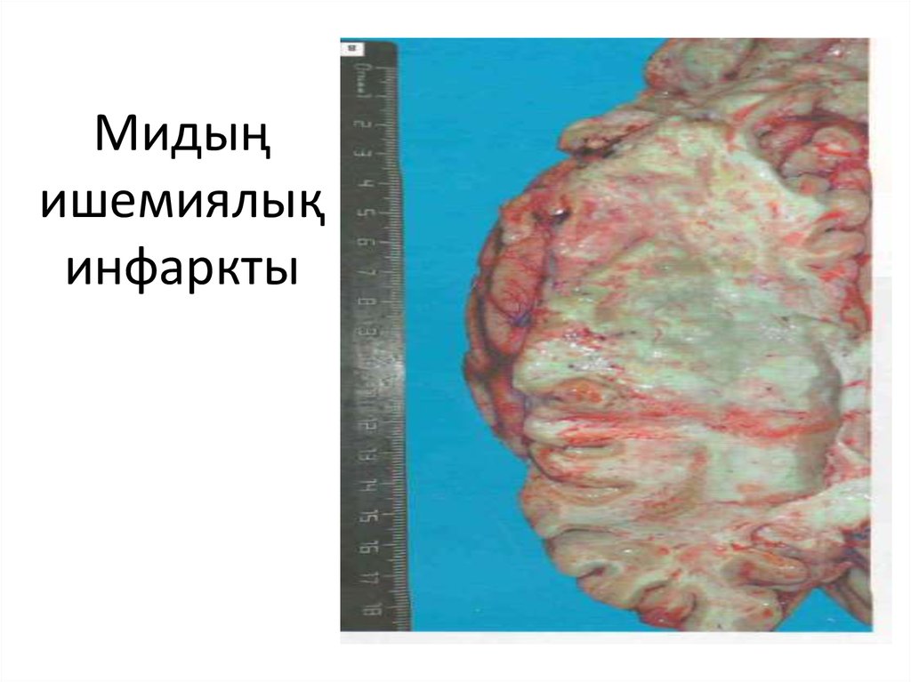 Мидың ишемиялық инфаркты