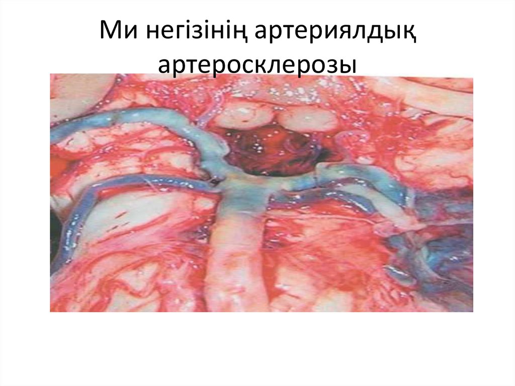 Ми негізінің артериялдық артеросклерозы