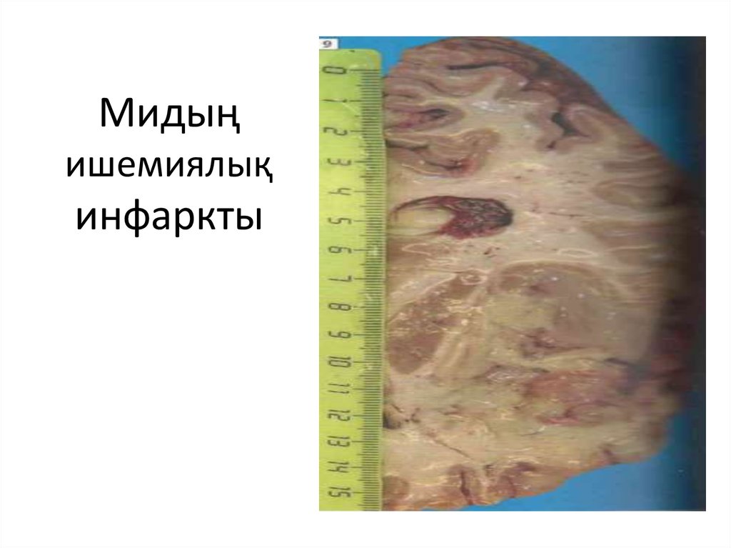 Мидың ишемиялық инфаркты