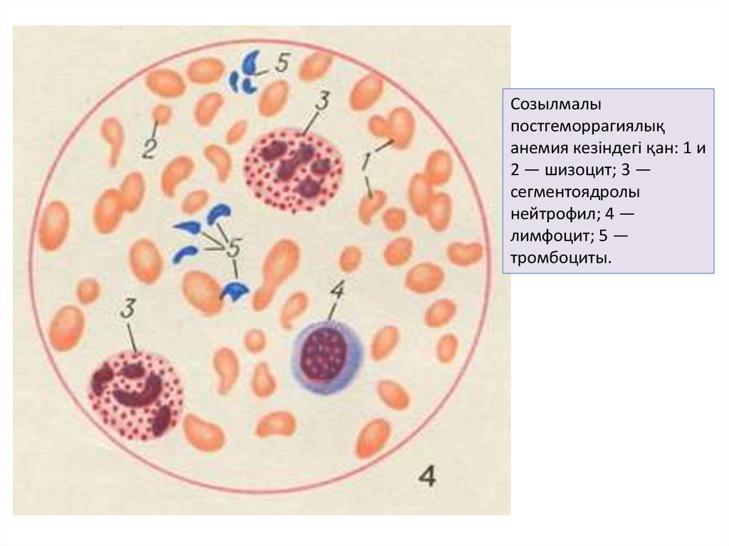 Картины анемии. Острая постгеморрагическая анемия картина крови. Постгеморрагическая анемия мазок крови. Картина крови при постгеморрагической анемии. Картина крови при хронической постгеморрагической анемии.