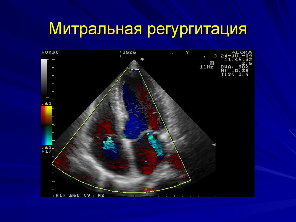 Регургитация митрального клапана. Митральная регургитация ЭХОКГ. ЭХОКГ митральная регургитация 1 степени. Митральная недостаточность ЭХОКГ. Доплер митральная недостаточность.