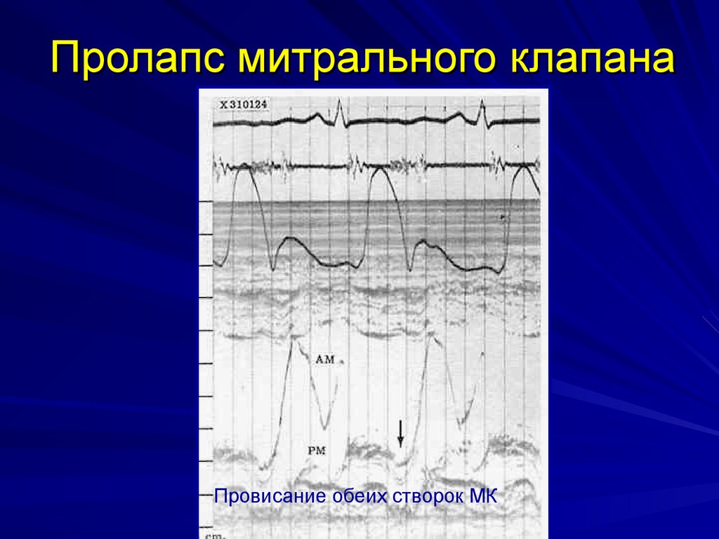 Где располагается митральный клапан