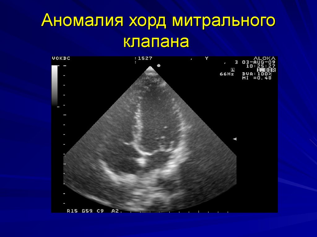 Дополнительная хорда желудочка. Удлиненная хорда митрального клапана. Отрыв хорды митрального клапана на УЗИ. Отрыв хорды митрального клапана ЭХОКГ. ЭХОКГ ложная хорда.