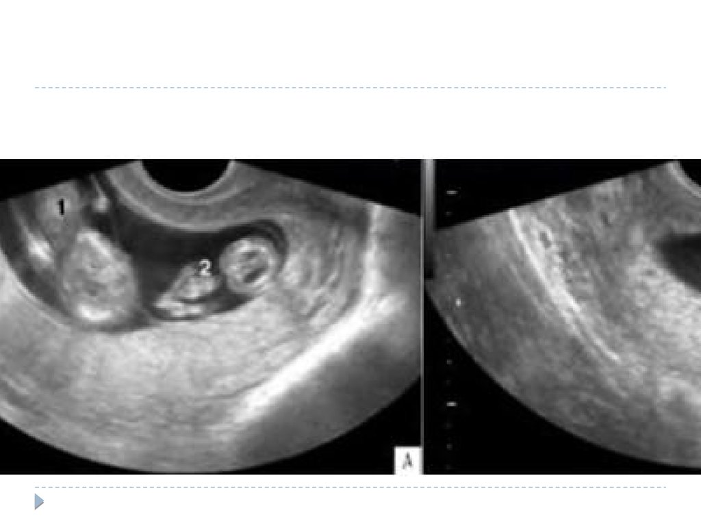 Амниотический тяж. Фето-фетальный трансфузионный синдром УЗИ. Монохориальная беременность УЗИ. Амниотическая перегородка в полости матки при беременности. Амниотическая перегородка при беременности двойней.