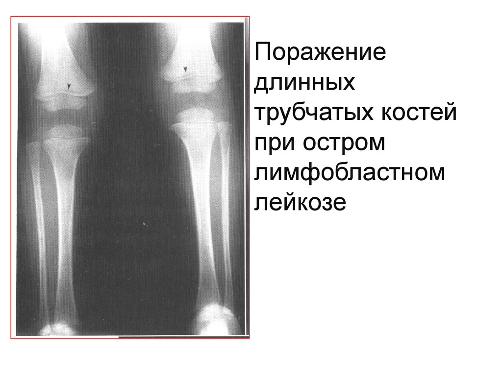 Поражение костей. Костно суставной синдром при остром лейкозе. Поражение костей при лейкозе рентген. Поражение трубчатых костей при остром лейкозе. Изменения костей при лейкозе.