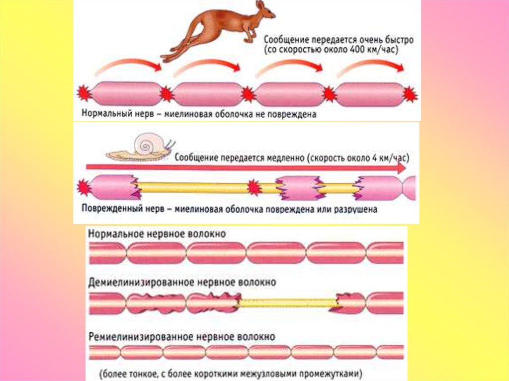 Демиелинизированные заболевания. Патофизиология нервной системы. Нервные волокна патофизиология. Свинка это патофизиология. Зайчик патофизиология.