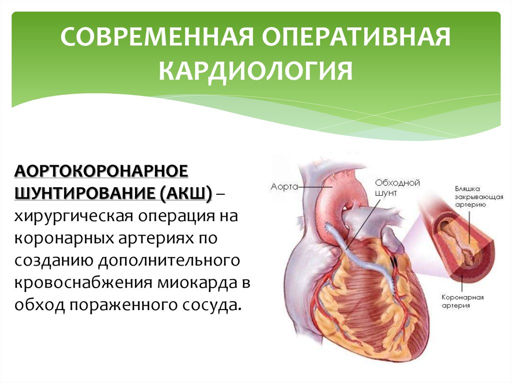 Шунтирование сердце простыми словами операция что такое. Хирургические методы лечения инфаркта миокарда. Аортокоронарное шунтирование. Портально коронарное шунтирование. Современная Оперативная кардиология.