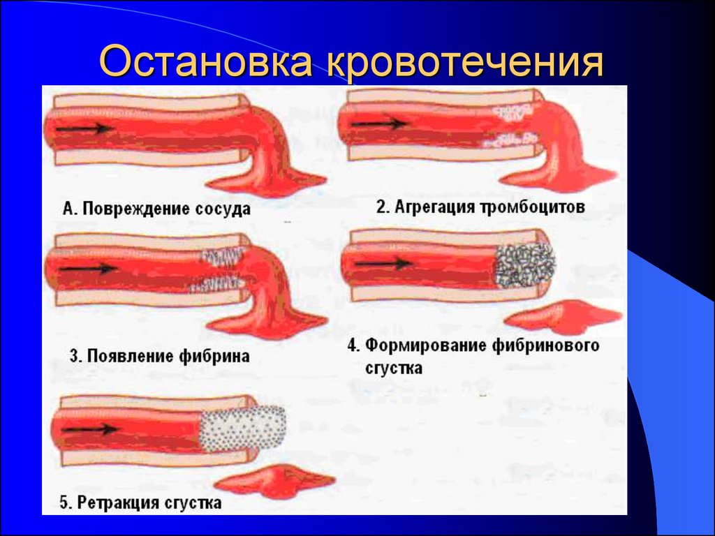 Изображение повреждено. Кровотечение и гемостаз. Разрыв кровеносного сосуда.