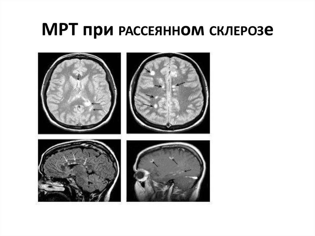 Фото мрт при рассеянном склерозе