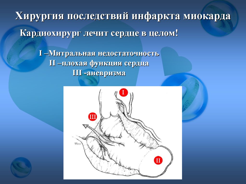 Инфаркт последствия. Последствия инфаркта миокарда. Митральная недостаточность операция. Последствия инфаркта миокарда у мужчин. Сердечный приступ последствия.