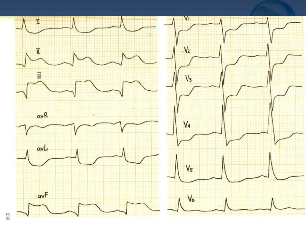 Рисунок кардиограммы сердца при инфаркте миокарда