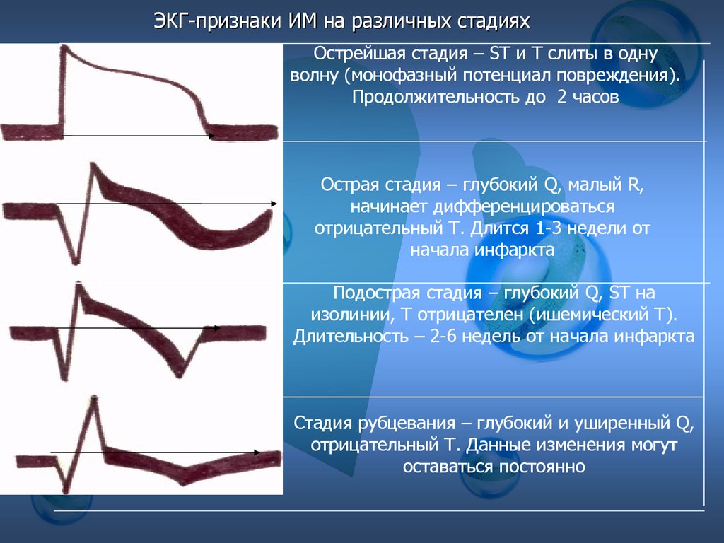 Разные стадии. Признак острейшей стадии инфаркта миокарда. Острая фаза инфаркта миокарда ЭКГ. Острейшая стадия инфаркта миокарда ЭКГ. Инфаркт миокарда на ЭКГ по стадиям.