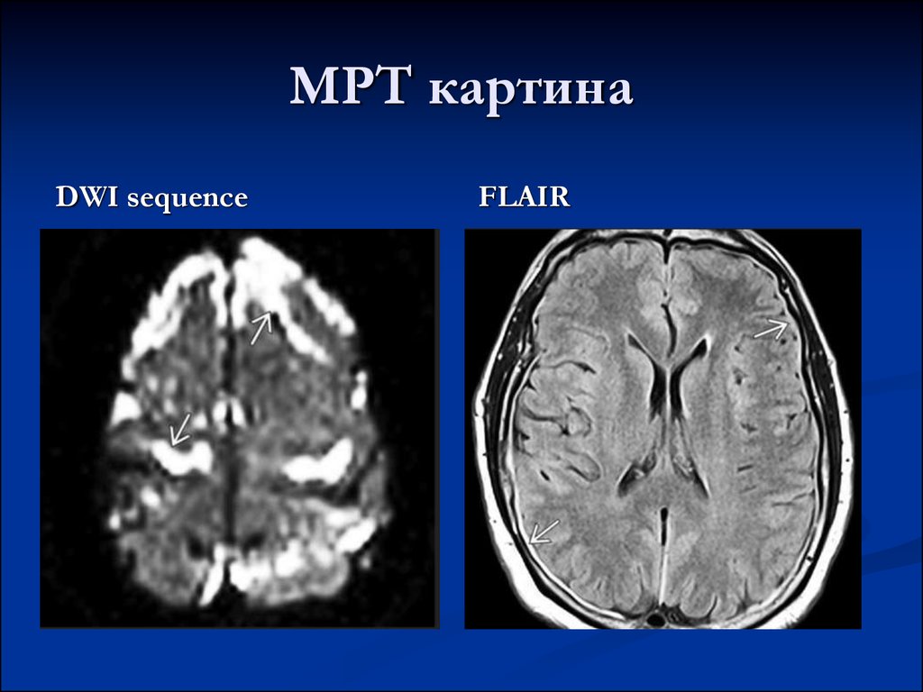 Режимы мрт головного мозга. Dwi мрт. Dwi режим мрт. Мрт картина. Flair мрт.