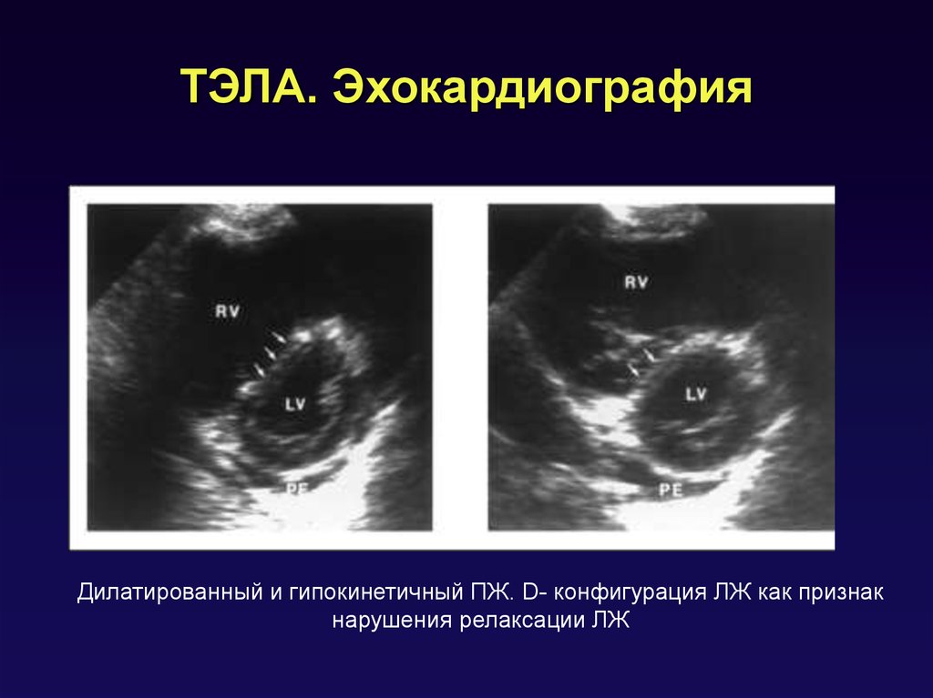 Признак 60 60. Признаки Тэла по ЭХОКГ. Эхокардиография при Тэла. Тромбоэмболия легочной артерии на ЭХОКГ. ЭХОКГ при Тэла.