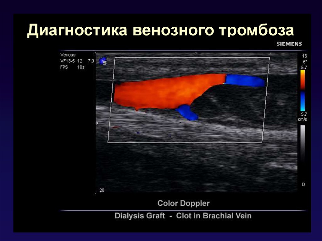 Диагностика тромбофлебита. Ультразвуковое цветное дуплексное сканирование тромбоз. Тромбоз нижних конечностей УЗИ. Тромбофлебит ультразвуковое дуплексное ангиосканирование..
