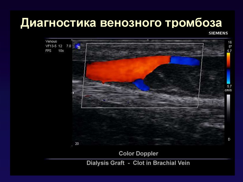 Узи вен тромбоз. Ультразвуковое цветное дуплексное сканирование тромбоз. Тромбоз нижних конечностей УЗИ. Тромбофлебит ультразвуковое дуплексное ангиосканирование..