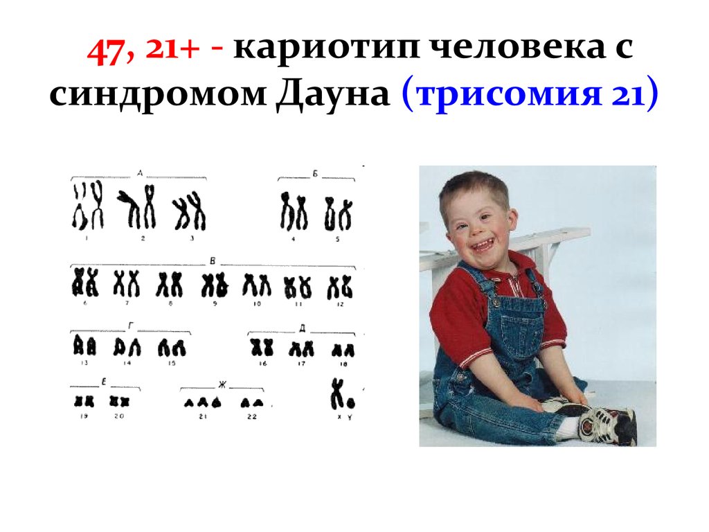 Количество хромосом в кариотипе человека. Кариотип человека с синдромом Дауна. Болезнь Дауна кариотип. Кариотип болезни синдрома Дауна. Кариограмма хромосом Дауна.