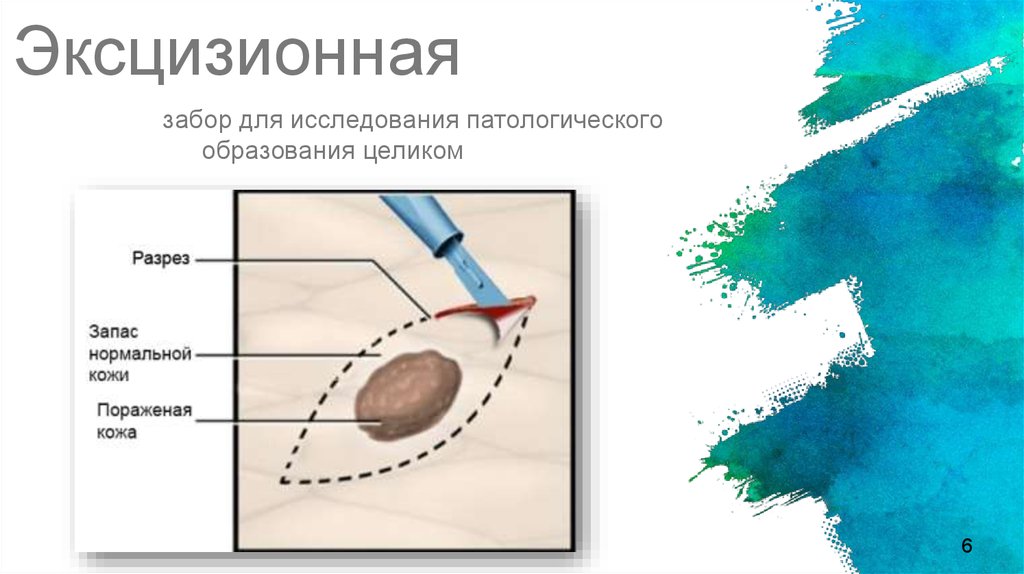 Биопсия при меланоме