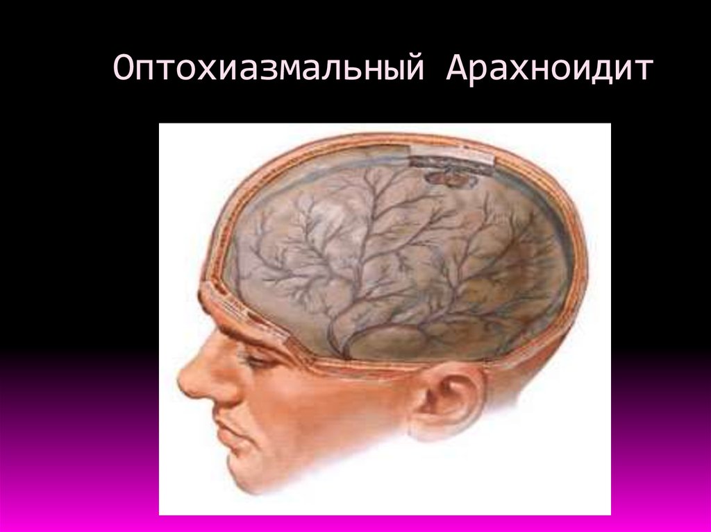 Диффузная церебральная. Оптико-хиазмальный арахноидит мрт. Базилярный арахноидит. Посттравматический арахноидит головного мозга.
